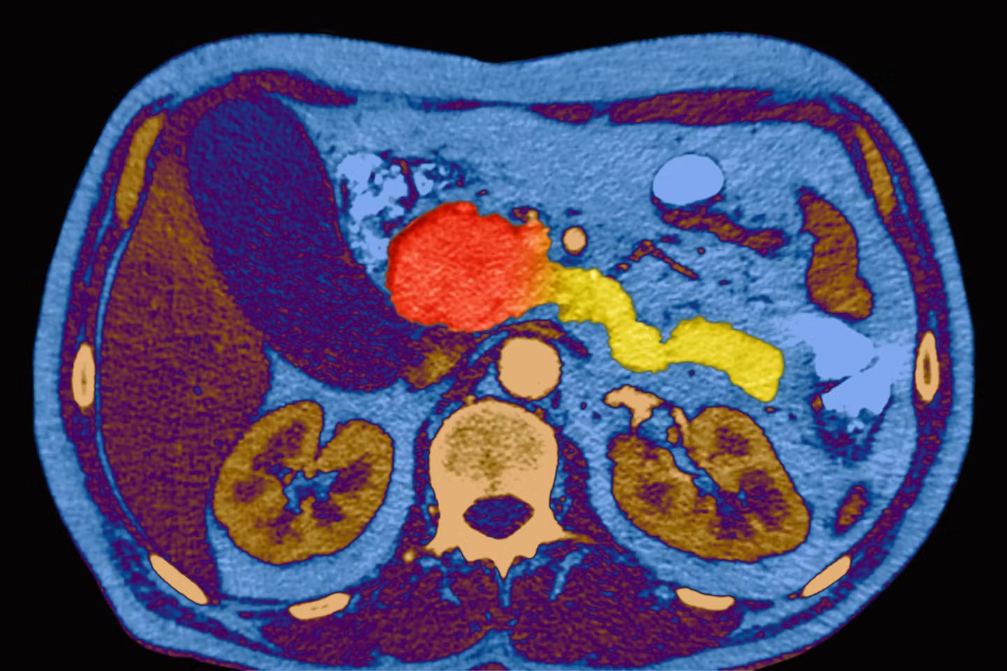 Cancer du pancreas un candidat medicament double la survie des patients