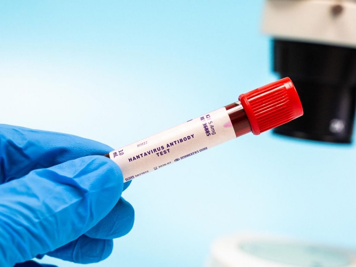 Test sanguin de dépistage des anticorps contre le hantavirus